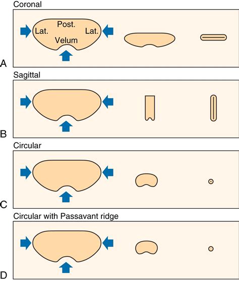 Velopharyngeal Dysfunction - Clinical Tree