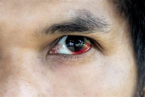 Subconjunctival Hemorrhage (Broken Blood Vessel in Eye) - Apollo Hospitals