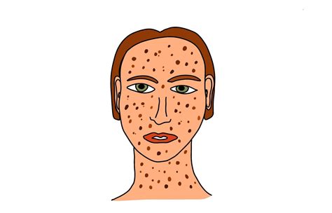 Skin Cancer Xeroderma Pigmentosum at Jean Tunstall blog