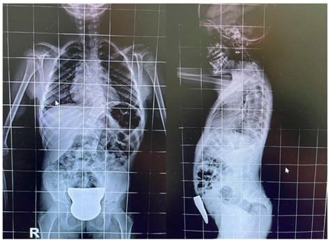The Synergistic Effects of Incobotulinum Toxin and Physiotherapy in a ...