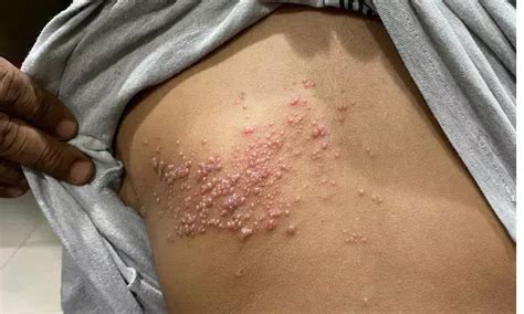 Crisugabalin Shows Significant Pain Reduction in Postherpetic Neuralgia ...