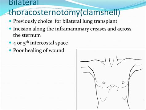 Image result for Clamshell Thoracotomy