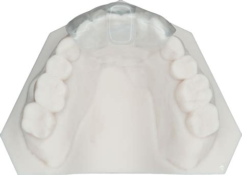 NTI Splint - Protec Dental