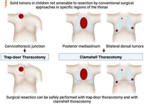 Image result for Clamshell Thoracotomy