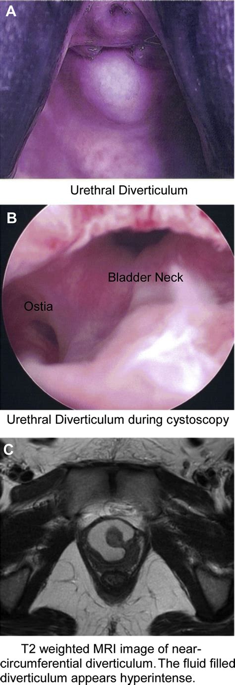 Urethral Masses - Obstetrics and Gynecology Clinics