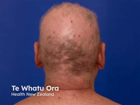 Image result for Diffuse Alopecia