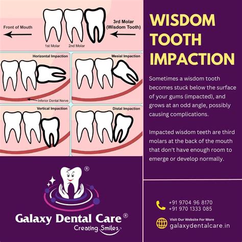 Image result for Wisdom Teeth Impaction Types