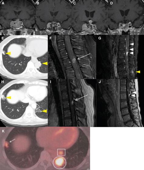 Figure 1 from An Adult Case of Sellar Atypical Teratoid/Rhabdoid Tumor Presenting with Lung ...
