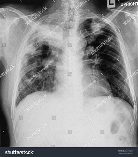 526 Atelectasis Images, Stock Photos & Vectors | Shutterstock