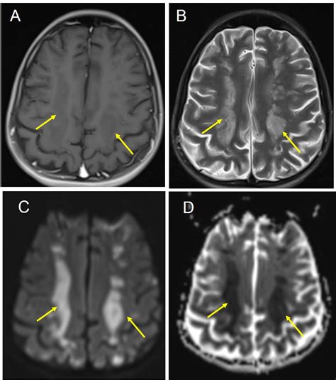 Watershed Brain Infarct