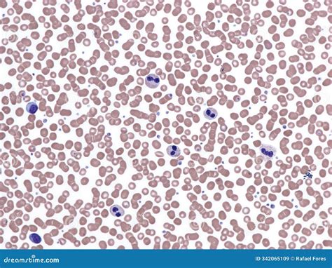 Pelger–Huët anomaly. stock image. Image of neutrophils - 342065109