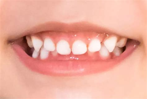 Among patients with Down syndrome occurrence of malocclusion higher ...