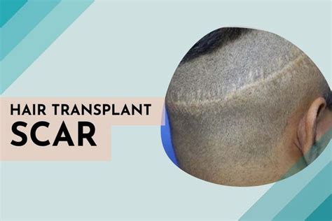 Understanding ingrown toenails and its removal