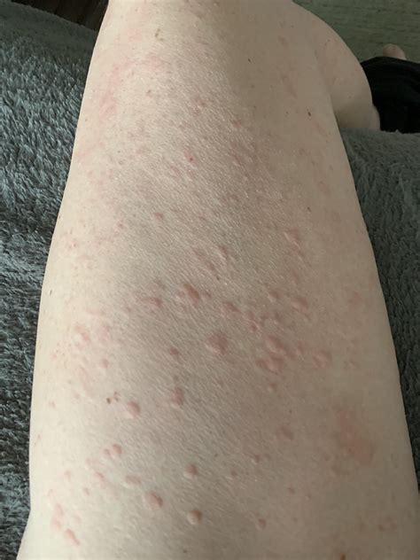Do these look like hives? : r/hives