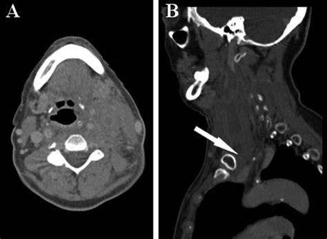 Internal Jugular Vein Catheter Thrombosis at Anthony Menard blog