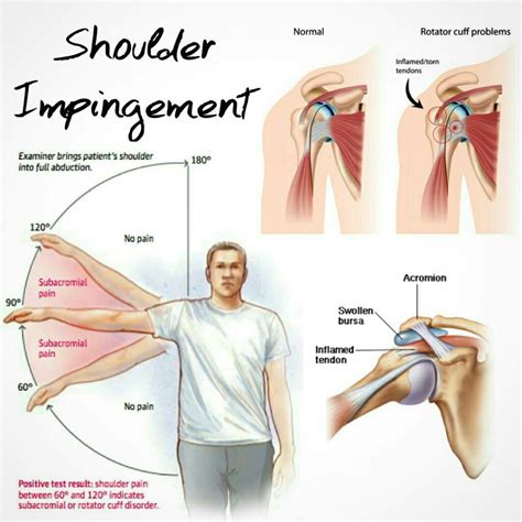 Shoulder Impingement/Rotator Cuff Tendinitis – Health Happening