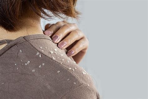 Seborrheic Dermatitis: Causes, Treatment, Home Remedies