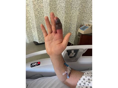 Copperhead Snake Bite In Palisades Sends Man To NJ Hospital | Ridgewood ...