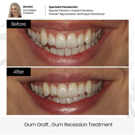 Receding Gums Surgery Before And After Receded Gums Treatment Includes