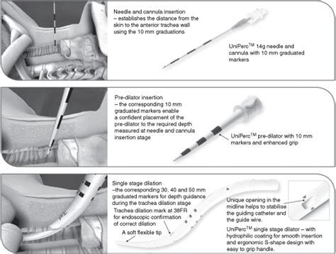 Image result for Trach Procedure