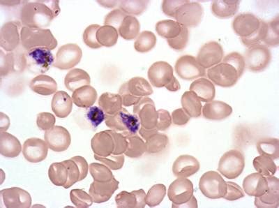 Plasmodium Falciparum from Images of Giemsa for Malaria Detection ...
