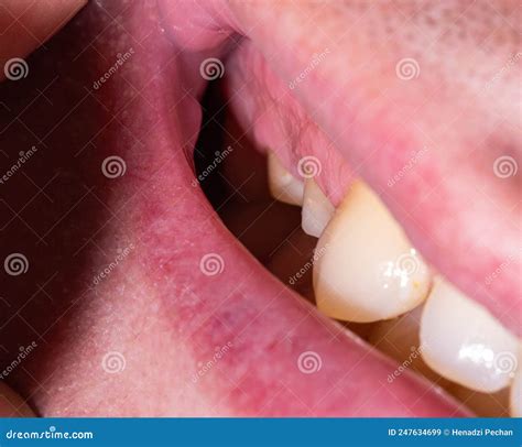 Decayed Tooth Pulling 的图像结果