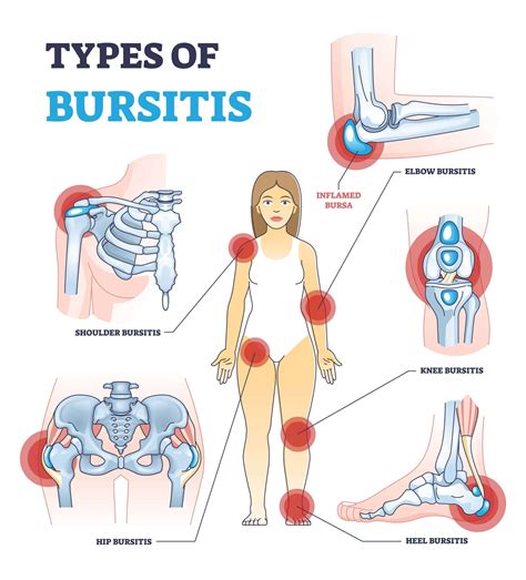 Severe Symptoms Of Hip Bursitis