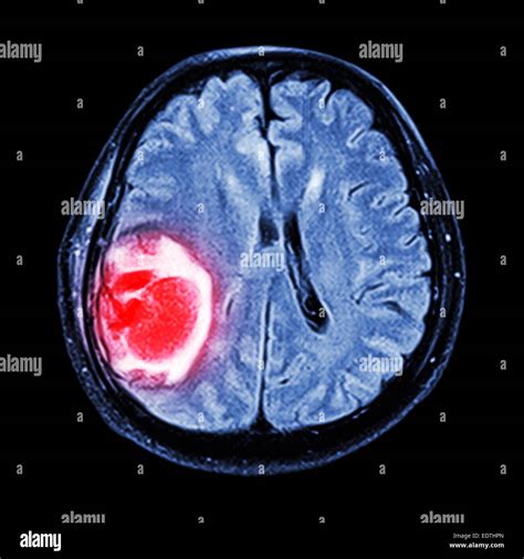Frontal Lobe Brain Tumor Mri