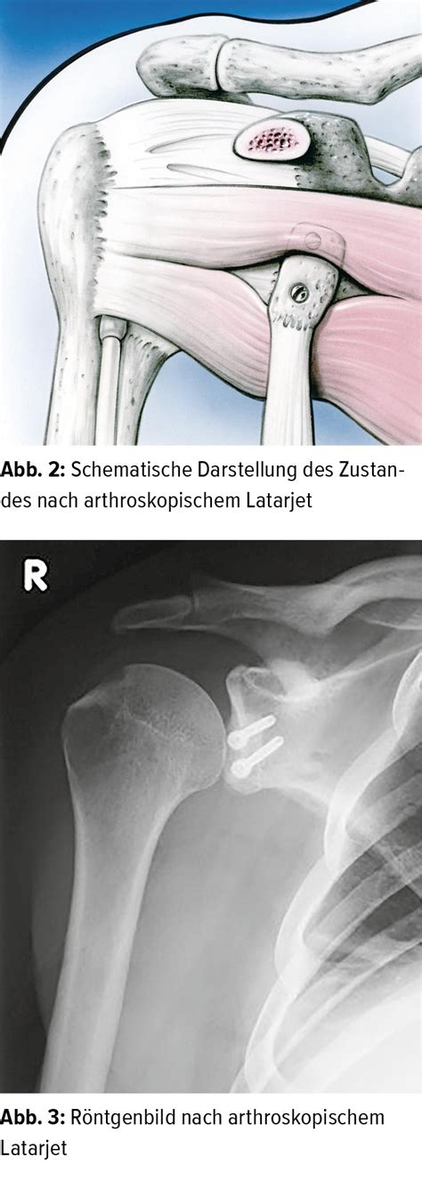 Glenohumerale Instabilität: Diagnostik und Therapie - Orthopädie ...