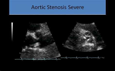Echocardiography Aortic Stenosis