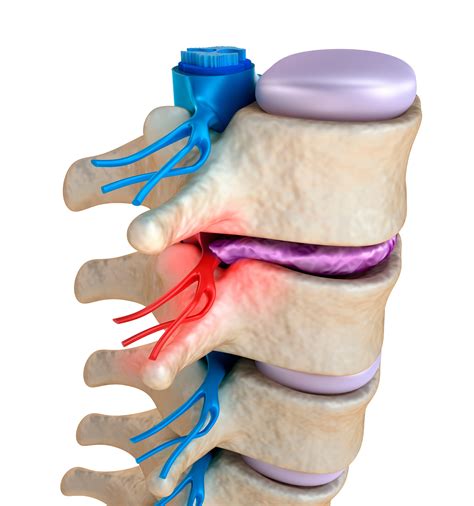 Disc Prolapse In The Neck