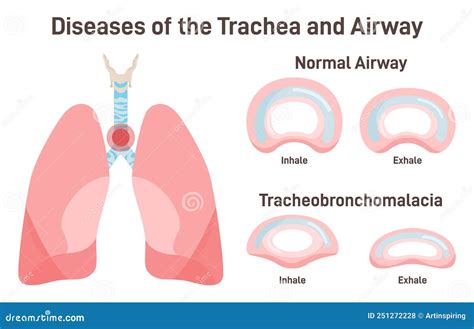 Tracheal And Bronchial Malacia at Cooper Meares blog