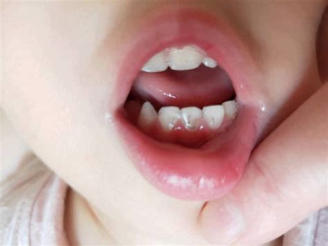 宝宝牙齿有黑点怎么办_宝宝二岁二个月，不知道什么时候开始有的_宝宝树