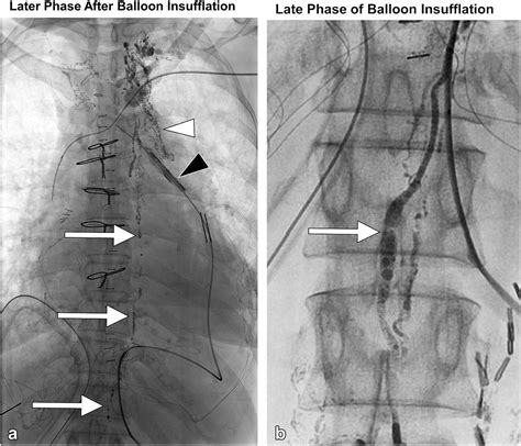 Balloon-Assisted Tamponade of the Lymphovenous Junction: An Adjunctive Technique for Thoracic ...