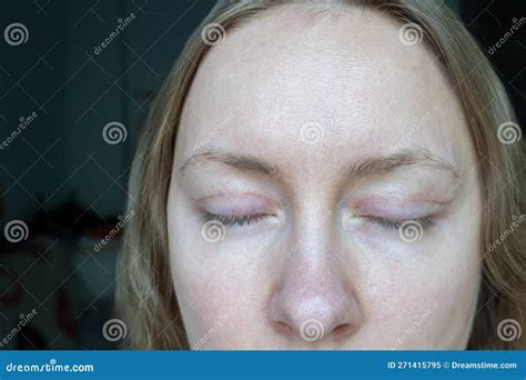 Woman Face after Plastic Surgery on Eyes, Blepharoplasty Operation, Incisions Stitches, Healing ...