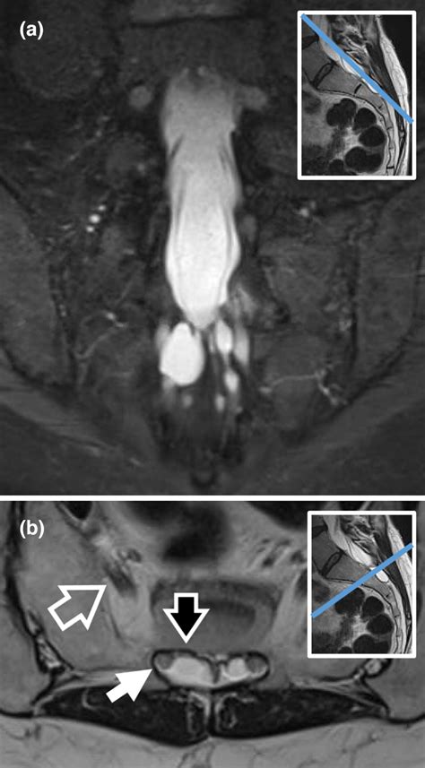 Sacral Tarlov cysts: Neurophysiology abnormalities and correlation with pelvic sensory and ...