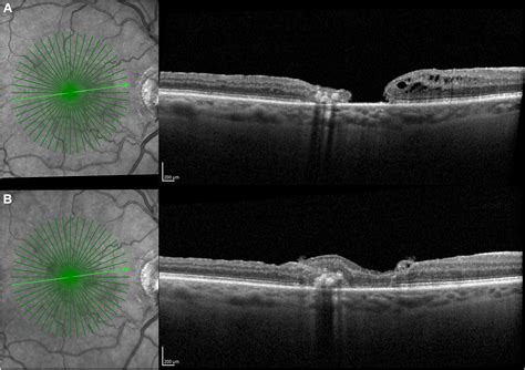 Surgical Management of Full-Thickness Macular Holes in Macular Telangiectasia Type 2 - Ophthalmology