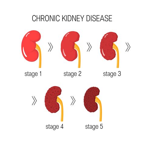 Stage 5 Chronic Kidney Disease: Medicare Options, Treatment, Life Expectancy, and More ...