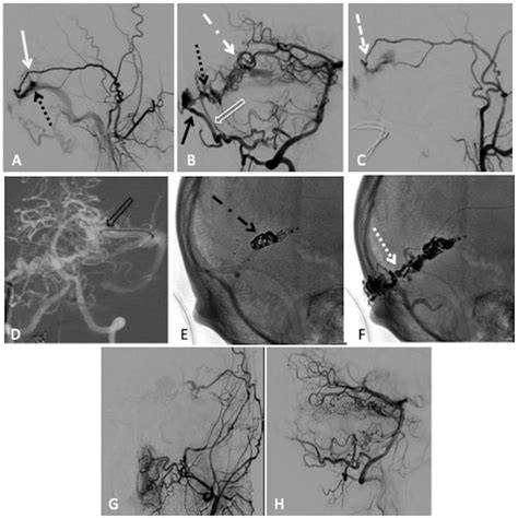 Updates in the management of cranial dural arteriovenous fistula ...