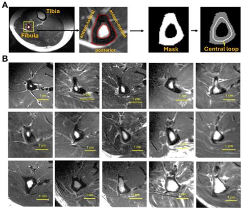 A 7T MRI Study of Fibular Bone Thickness and Density: Impact of Age ...