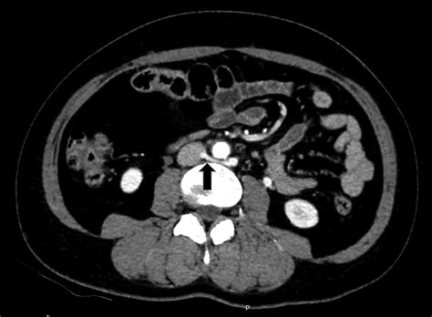 Nutcracker Syndrome Kidney at Caitlyn Tooth blog