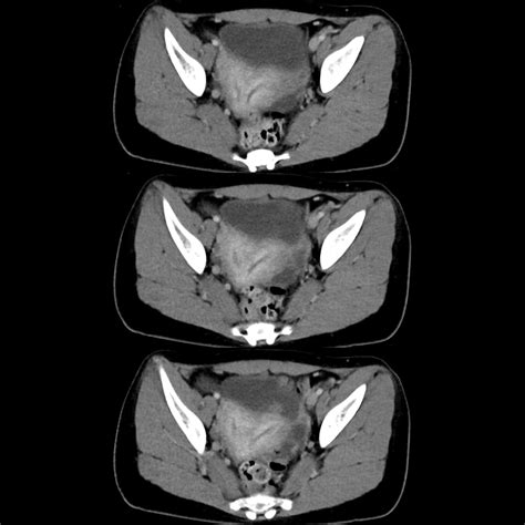 Pediatric Mullerian Duct Anomalies | Pediatric Radiology Reference Article | Pediatric Imaging ...