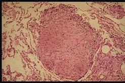 Image result for Caseous Granuloma