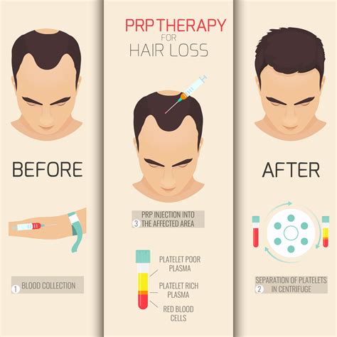 PRP Hair Treatment in India | Plasma Rich Hair treatment at Best Price - Blog