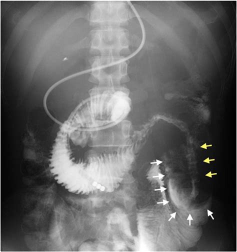 Image result for Contrast Fluoroscopy
