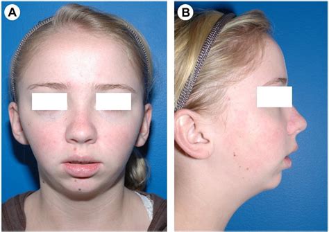 Histopathology of Idiopathic Condylar Resorption Differs From Temporomandibular Joint-Only ...