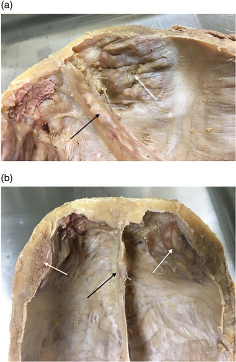 Space invaders: Reassessing the histology of hyperostosis frontalis interna - Hogg - 2024 - The ...