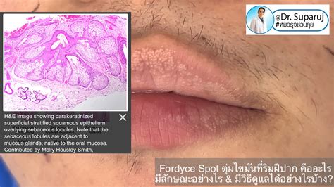 Fordyce Spot ตุ่มไขมันที่ริมฝีปาก คืออะไร มีลักษณะอย่างไร & มีวิธีดูแลได้อย่างไรบ้าง?