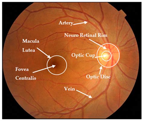 Automated Glaucoma Screening and Diagnosis Based on Retinal Fundus Images Using Deep Learning ...