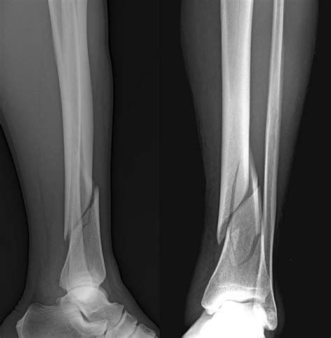 Broken Tibia And Fibula